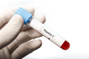 Понятие вирусной нагрузки при гепатите С: как проводится исследование, на что влияет этот фактор, Гепатит C