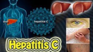 Стадии острого и хронического гепатита С, Гепатит C